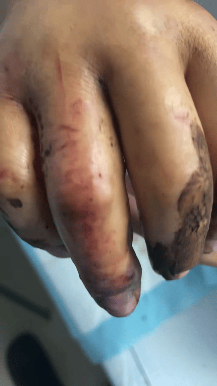 丹麦丙组联赛_男子被毒蛇咬伤拦车自救丹麦丙组联赛?当事人讲述:当时可能把手指直接伸向了蛇嘴里